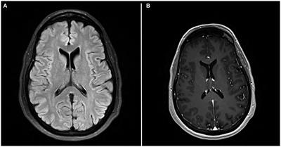 Case report: A novel case of paraneoplastic voltage gated calcium channel antibodies secondary to appendiceal adenocarcinoma